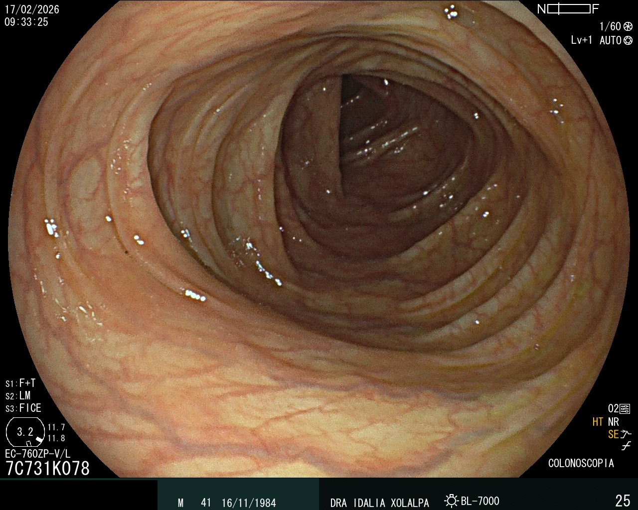 Hallazgo endoscópico - Colon Normal