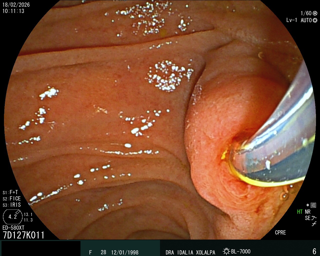 Caso clínico - CPRE Diagnóstica