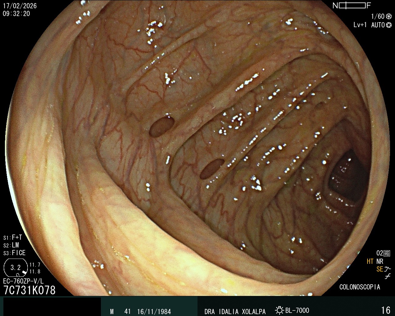 Hallazgo endoscópico - Divertículos