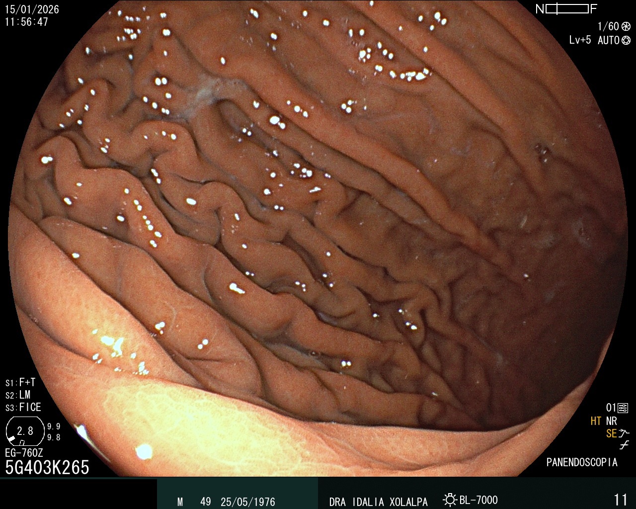 Hallazgo endoscópico - Estómago Normal