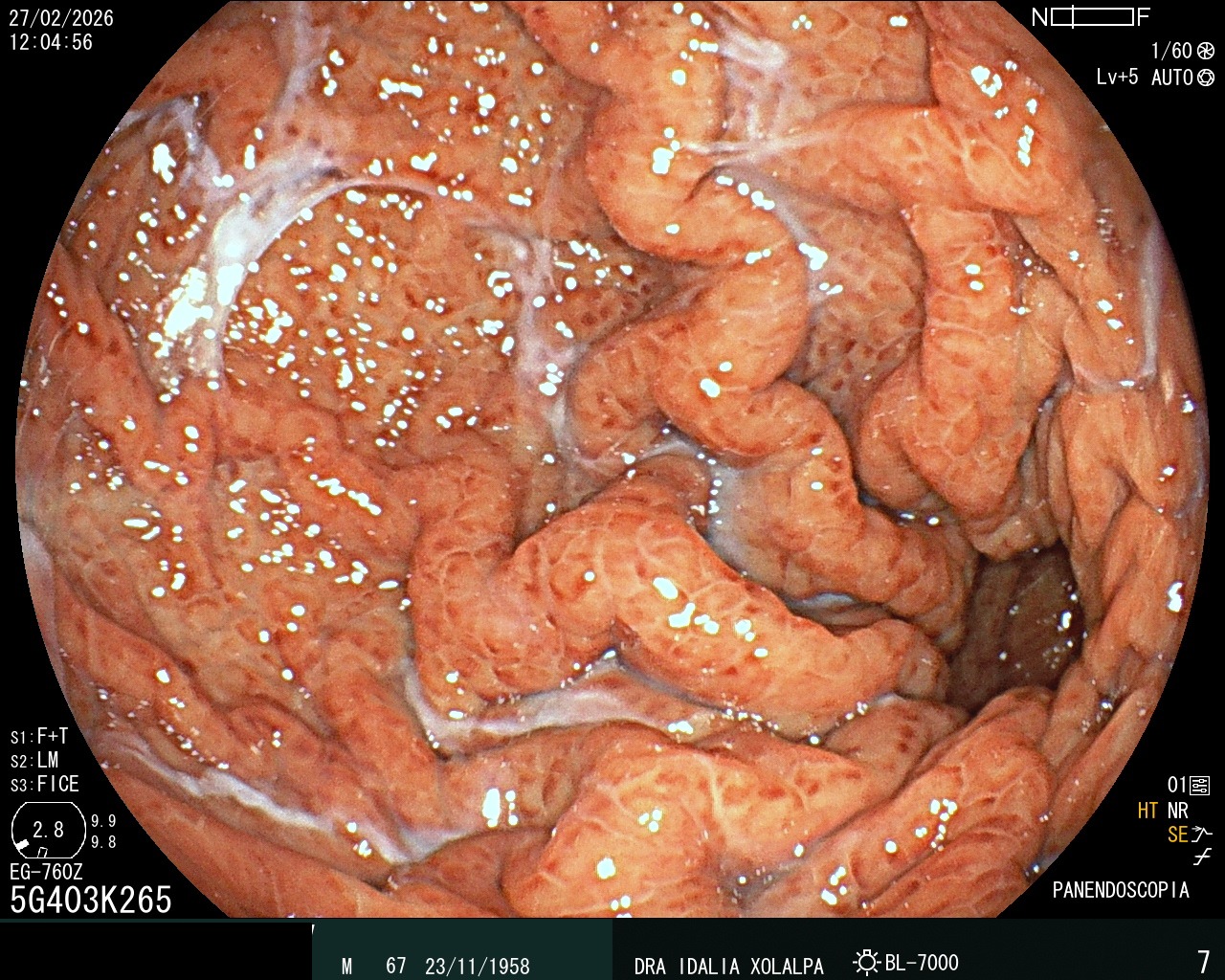 Hallazgo endoscópico - Gastritis