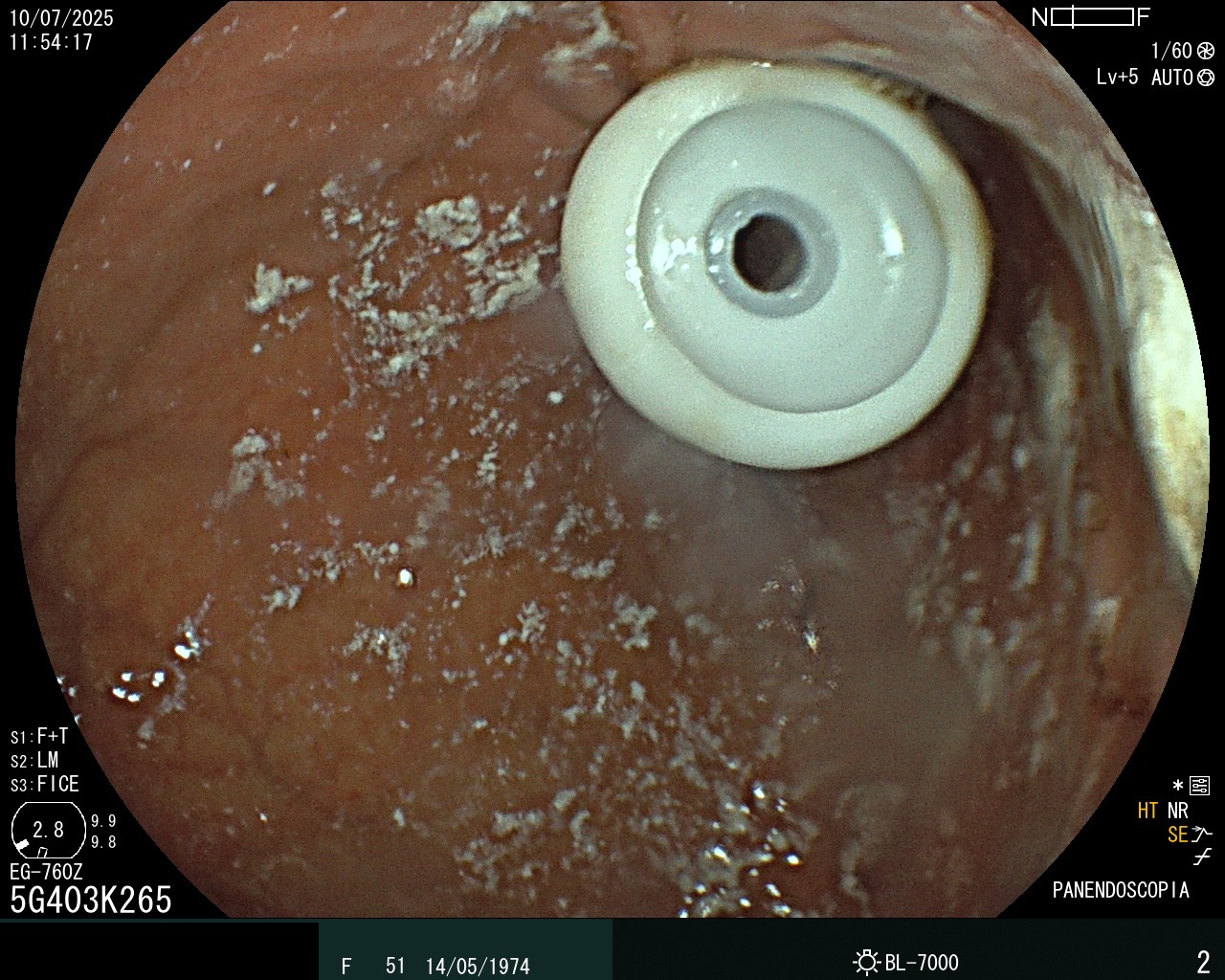 Caso clínico - Gastrostomía Endoscópica