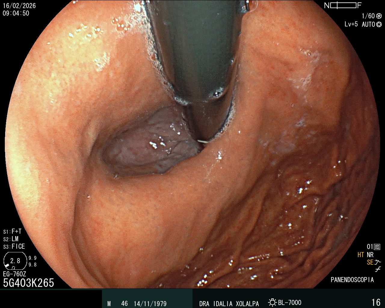 Hallazgo endoscópico - Hernia Hiatal