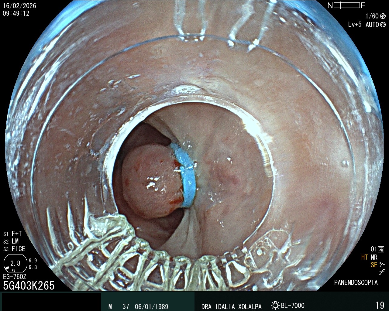 Caso clínico - Ligadura de Várices Esofágicas