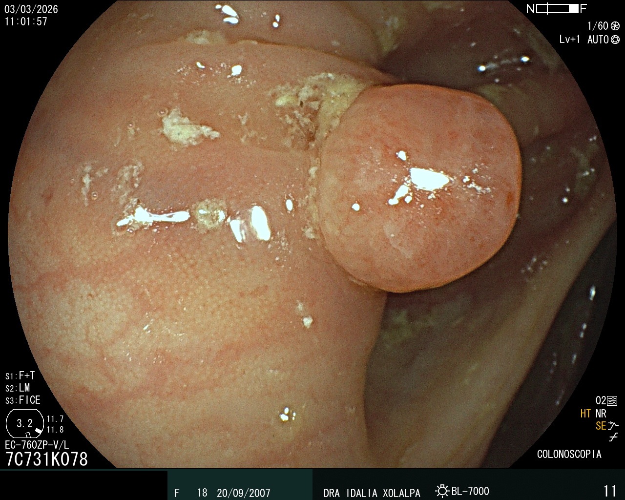 Hallazgo endoscópico - Pólipo de Colon