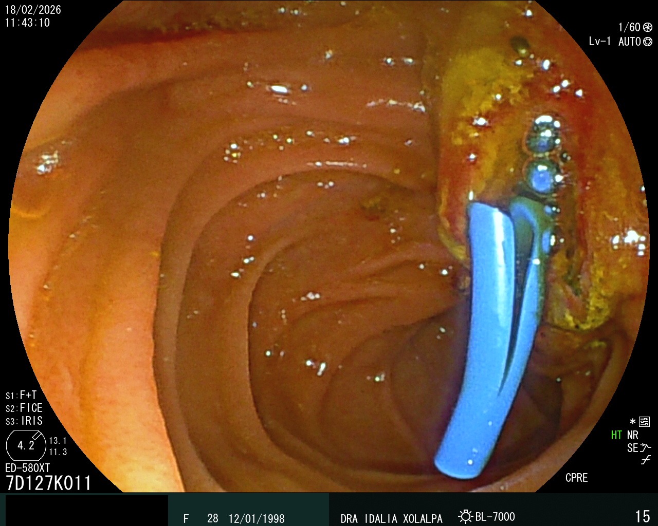 Caso clínico - Prótesis Biliar