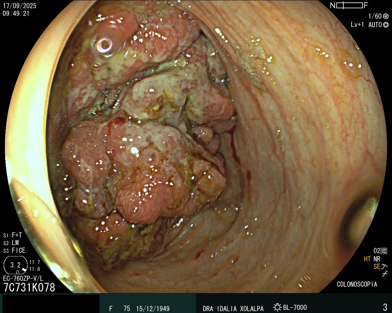Hallazgo endoscópico - Tumor de Colon