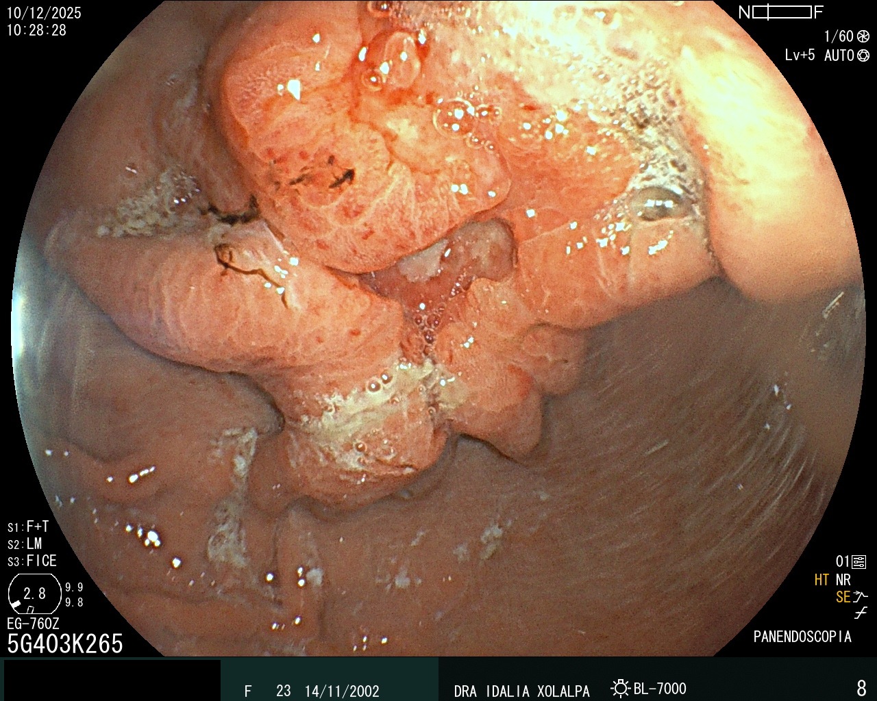Hallazgo endoscópico - Tumor Gástrico